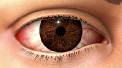 New treatment for severe corneal inflammation from DED now listed on PBS