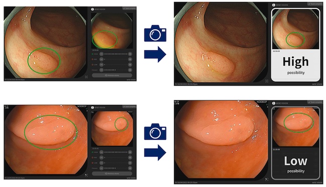 NEC's artificial intelligence (AI) supports doctors to determine if colorectal lesions are potentially neoplastic