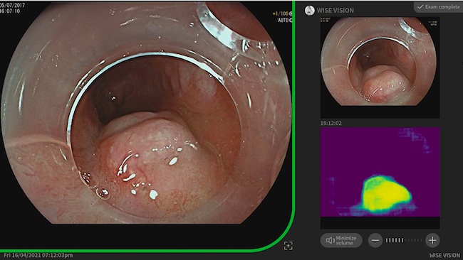 NEC's AI Supports Doctors to Detect Neoplasia in Barrett's Esophagus during Endoscopic Procedures