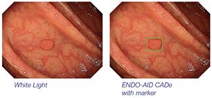 ENDO-AID CADe: real-time computer-aided detection for endoscopy