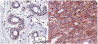 Novel Gene Predicts Both Breast Cancer Relapse and Response to Chemotherapy