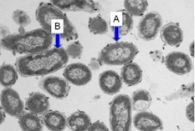 Ozone nano-bubble water: a potential treatment for severe gum infections